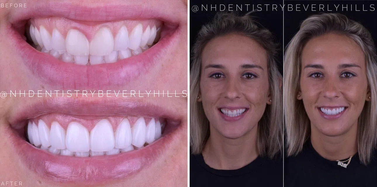 Veneer Smile Makeover Before & After Image