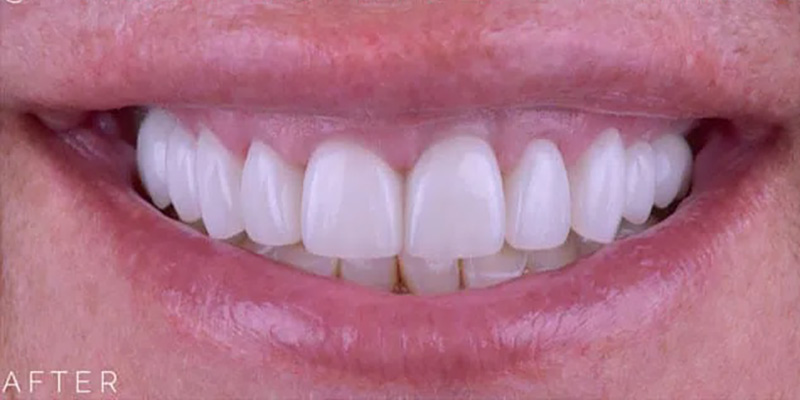 Dental Crowns Before & After Image