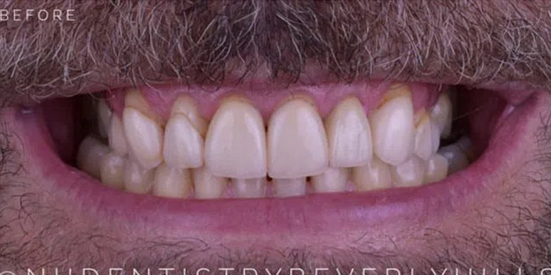 Dental Crowns Before & After Image