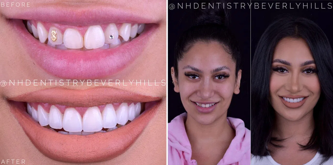 Veneer Smile Makeover Before & After Image